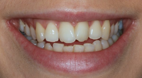 Dream Smile Dental - Invisalign Patient Before