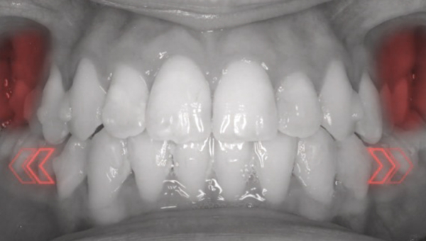 Dream Smile Dental - Unilateral Crossbite Correction