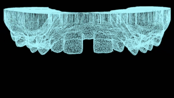 Dream Smile Dental - Composite Restoration