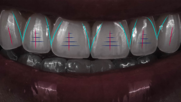Dream Smile Dental - Correcting Bite with Invisalign