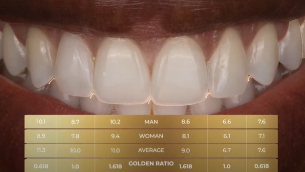 Dream Smile Dental - Composite Edge Bonding After Invisalign