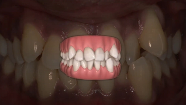 Dream Smile Dental - Significant Crowding