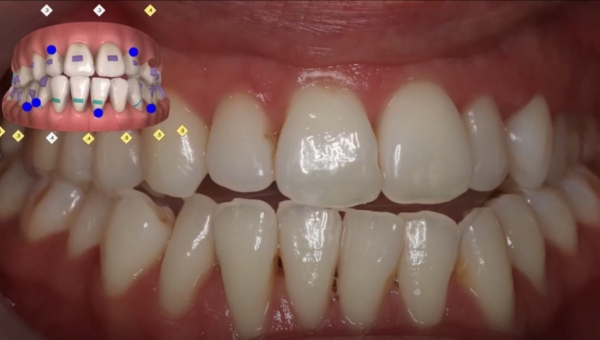 Dream Smile Dental - Significant Midline Correction