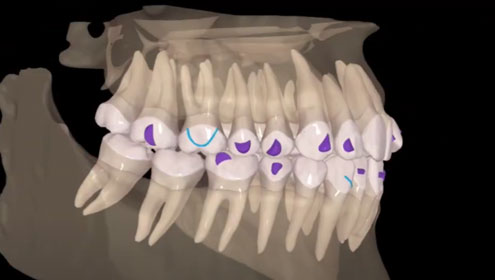 Dream Smile Dental - CBCT planning for Open bite