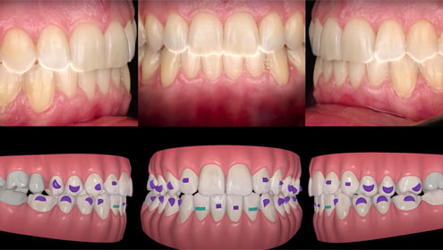 Dream Smile Dental - correct bite and crowding